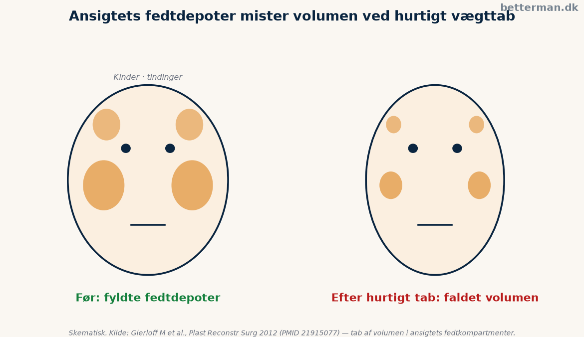 Illustration af fedtdepoter i ansigtet og hvordan volumen falder ved hurtigt vægttab, ozempic face