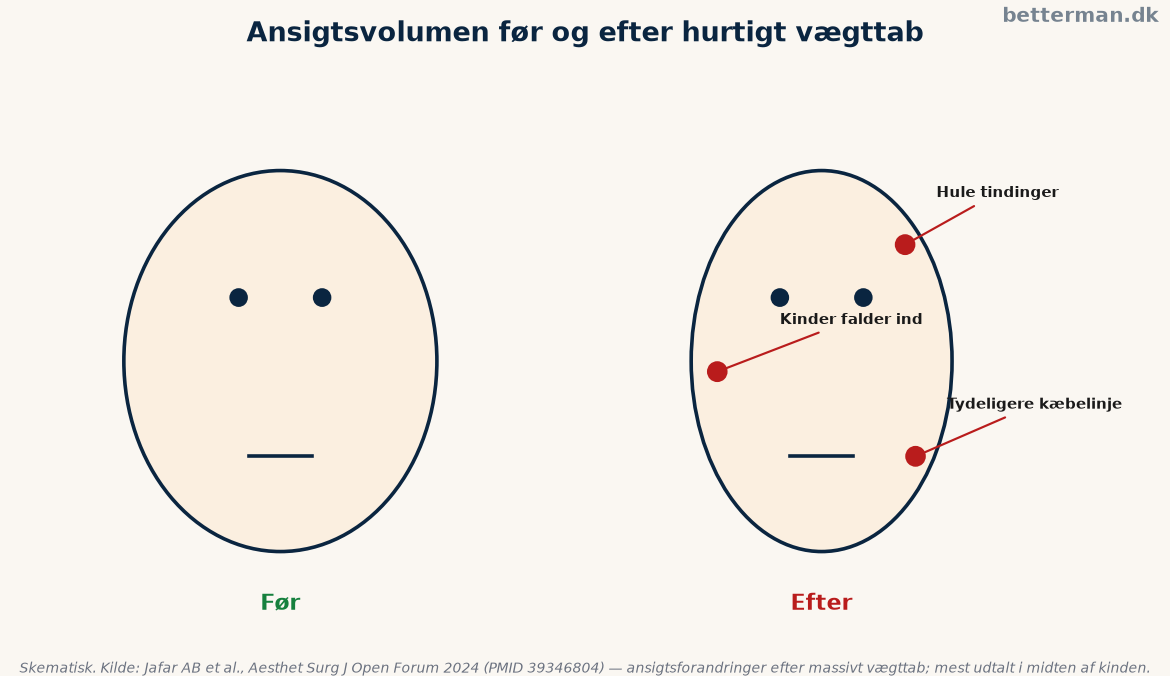Sammenligning af ansigtsvolumen før og efter hurtigt vægttab med markering af kinder, tindinger og kæbelinje